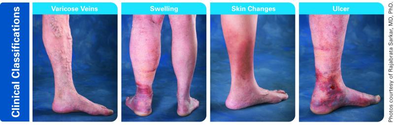 Skin changes associated with chronic venous insufficiency (CVI